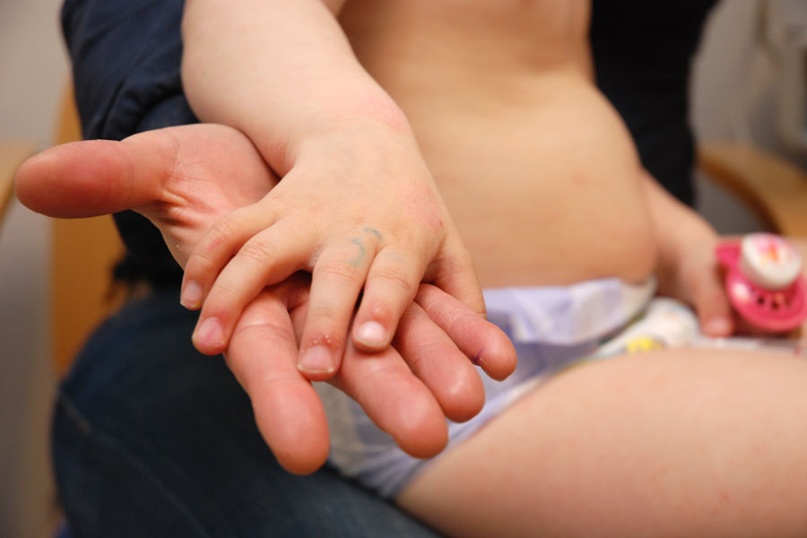 One in five children get eczema. Photo: Jan Fredrik Frantzen